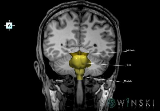 G6.T9.4.V1.P-50S.Brainstem–Triplanar