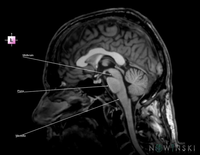 G6.T9.4.V2.P00.Brainstem–Triplanar.tiff