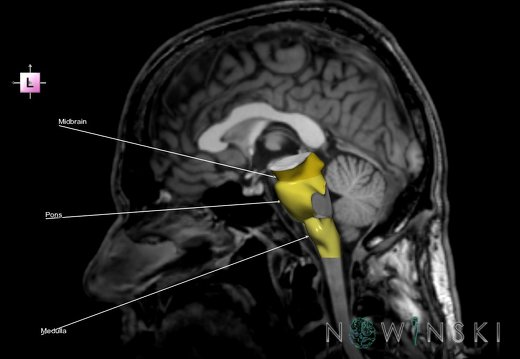 G6T9.4.Brainstem–Triplanar