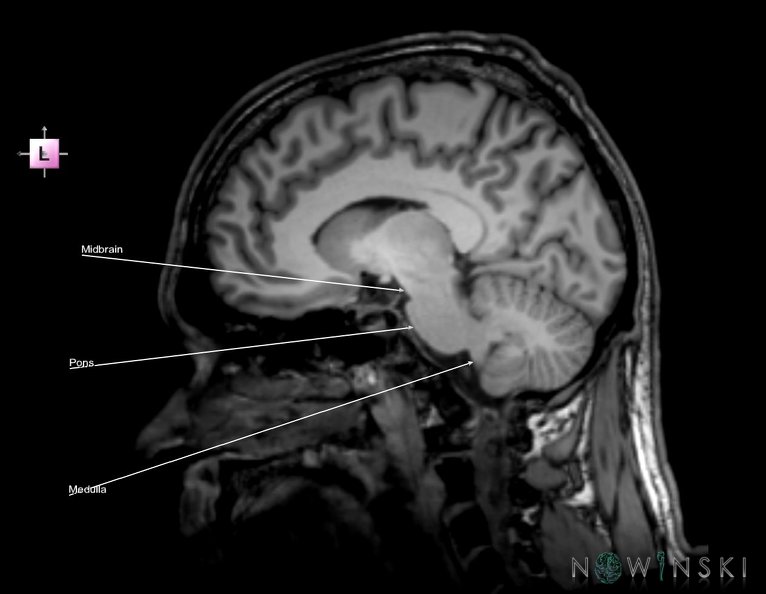 G6.T9.4.V2.P10.Brainstem–Triplanar.tiff