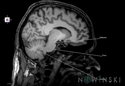 G6.T9.4.V4.P-10.Brainstem–Triplanar