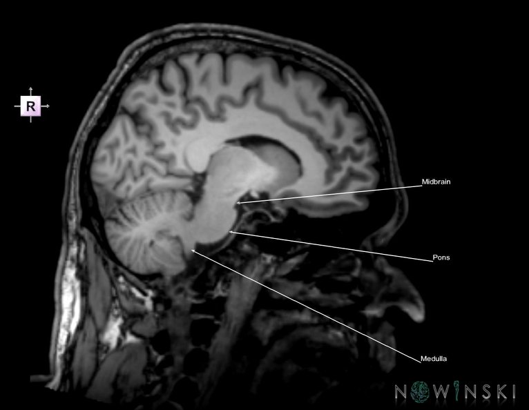 G6.T9.4.V4.P-10.Brainstem–Triplanar.tiff