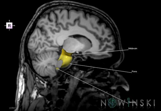 G6.T9.4.V4.P-10S.Brainstem–Triplanar