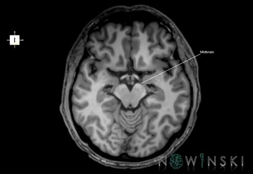 G6.T9.4.V6.P-10.Brainstem–Triplanar