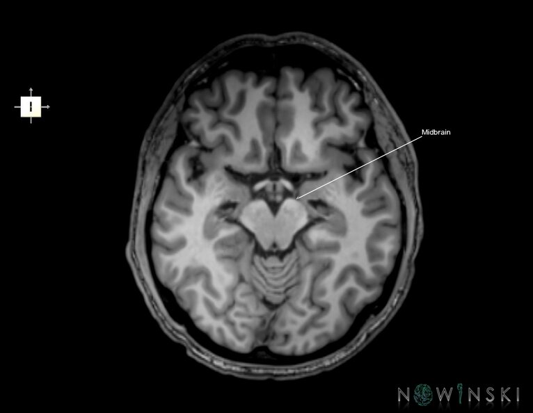 G6.T9.4.V6.P-10.Brainstem–Triplanar.tiff