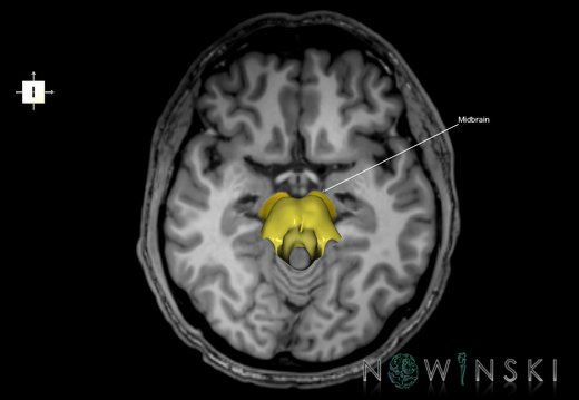 G6.T9.4.V6.P-10S.Brainstem–Triplanar