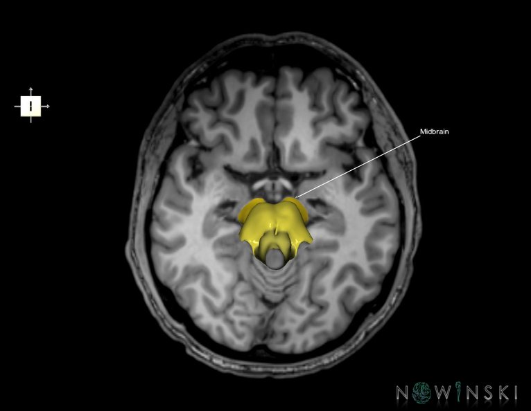 G6.T9.4.V6.P-10S.Brainstem–Triplanar.tiff