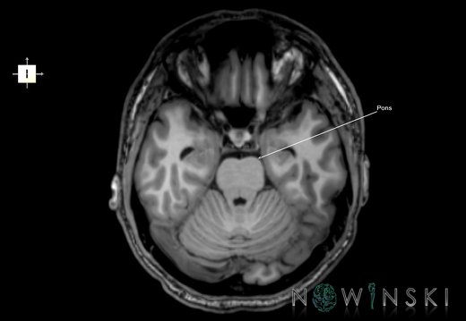 G6.T9.4.V6.P-20.Brainstem–Triplanar