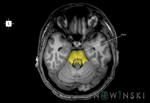 G6.T9.4.V6.P-20S.Brainstem–Triplanar