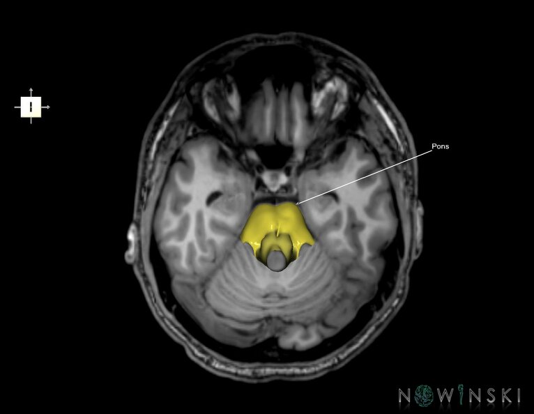 G6.T9.4.V6.P-20S.Brainstem–Triplanar.tiff