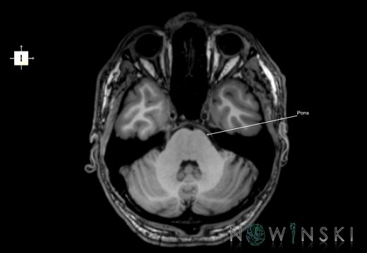 G6.T9.4.V6.P-30.Brainstem–Triplanar