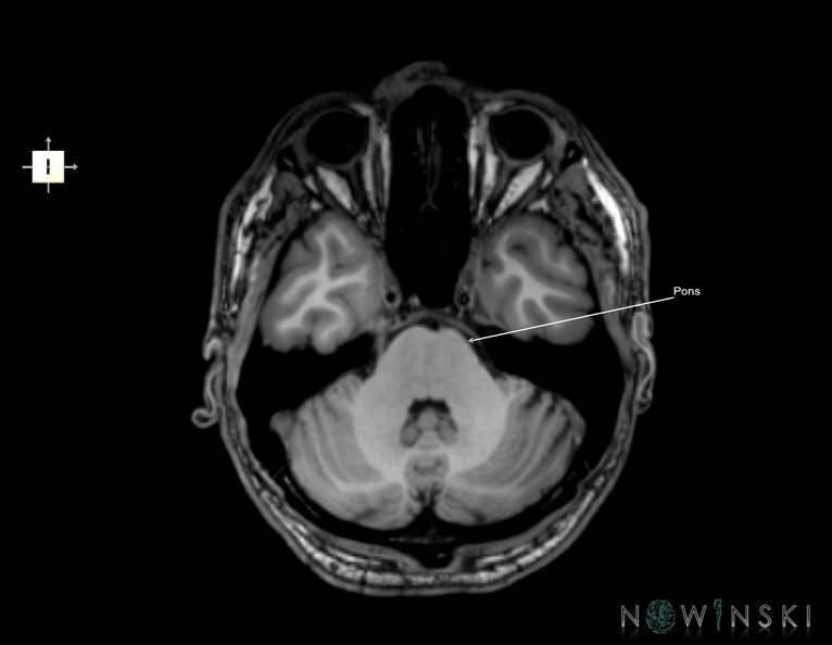 G6.T9.4.V6.P-30.Brainstem–Triplanar.tiff