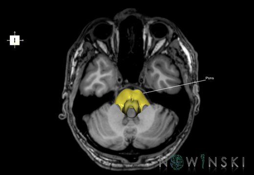 G6.T9.4.V6.P-30S.Brainstem–Triplanar