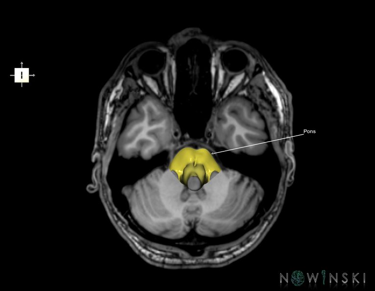 G6.T9.4.V6.P-30S.Brainstem–Triplanar.tiff