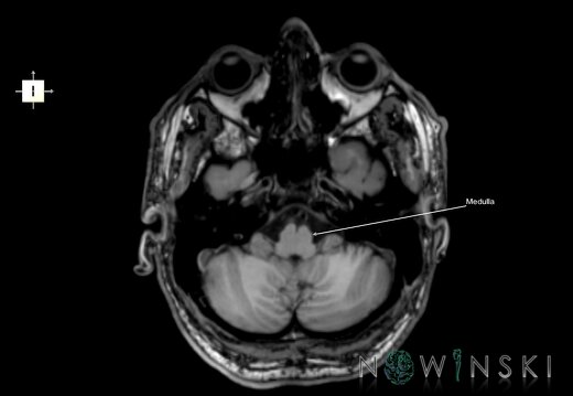 G6.T9.4.V6.P-40.Brainstem–Triplanar