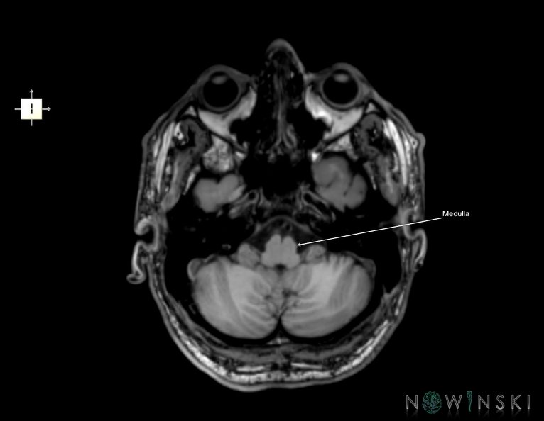 G6.T9.4.V6.P-40.Brainstem–Triplanar.tiff