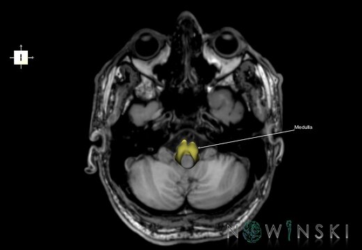 G6.T9.4.V6.P-40S.Brainstem–Triplanar