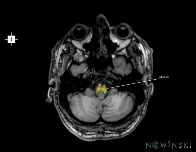 G6.T9.4.V6.P-40S.Brainstem–Triplanar.tiff