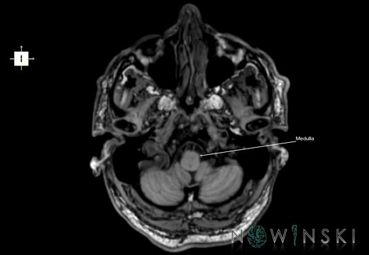 G6.T9.4.V6.P-50.Brainstem–Triplanar