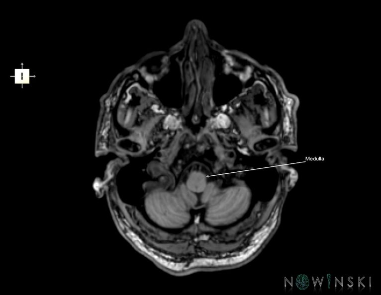 G6.T9.4.V6.P-50.Brainstem–Triplanar.tiff