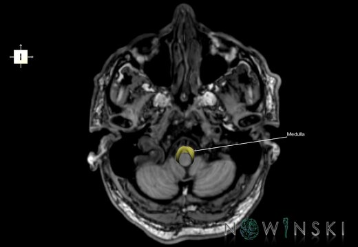 G6.T9.4.V6.P-50S.Brainstem–Triplanar