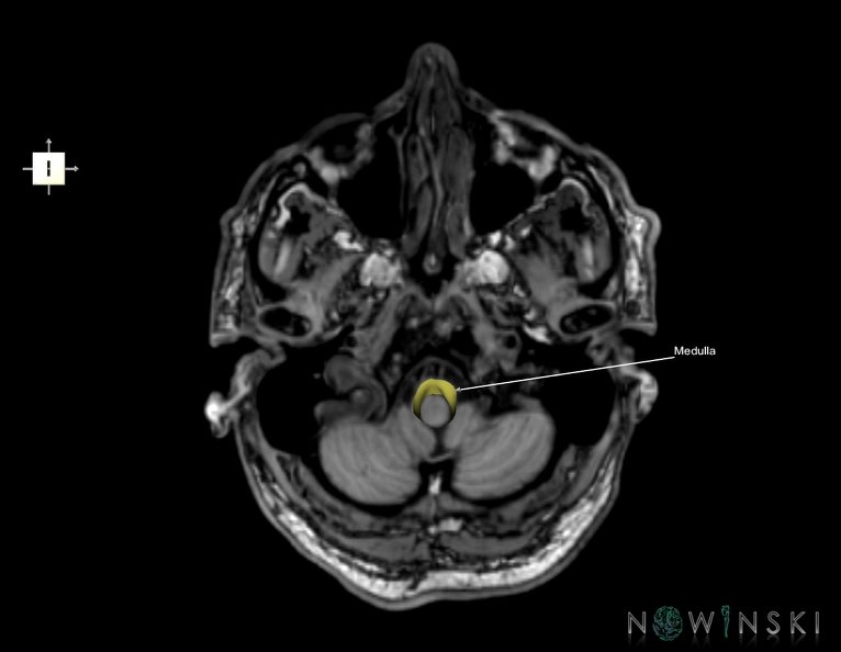 G6.T9.4.V6.P-50S.Brainstem–Triplanar.tiff