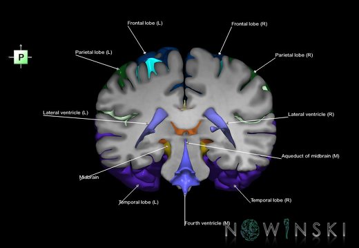 G7.T2.1-12.V3.Dp-30.C2.L1.Brain posterior cut–Cerebral ventricles