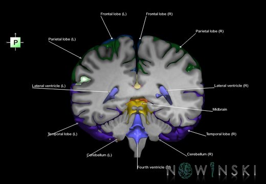 G7.T2.1-12.V3.Dp-40.C2.L1.Brain posterior cut–Cerebral ventricles