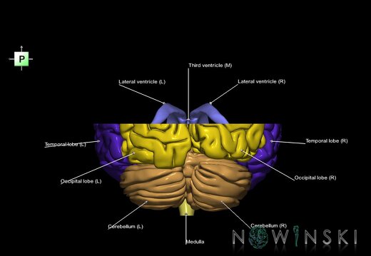 G7.T2.1-12.V3.Ds10.C2.L1.Brain superior cut–Cerebral ventricles