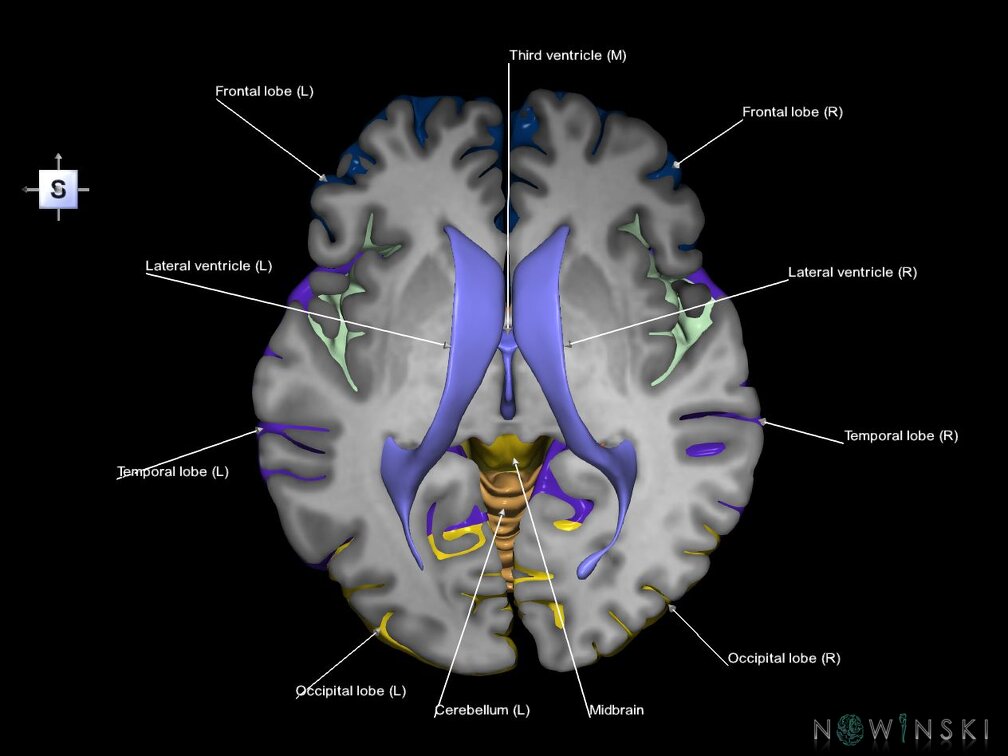 G7.T2.1-12.V5.Ds00.C2.L1.Brain superior cut–Cerebral ventricles