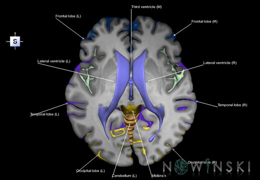 G7.T2.1-12.V5.Ds00.C2.L1.Brain superior cut–Cerebral ventricles