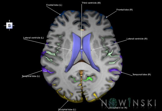 G7.T2.1-12.V5.Ds10.C2.L1.Brain superior cut–Cerebral ventricles