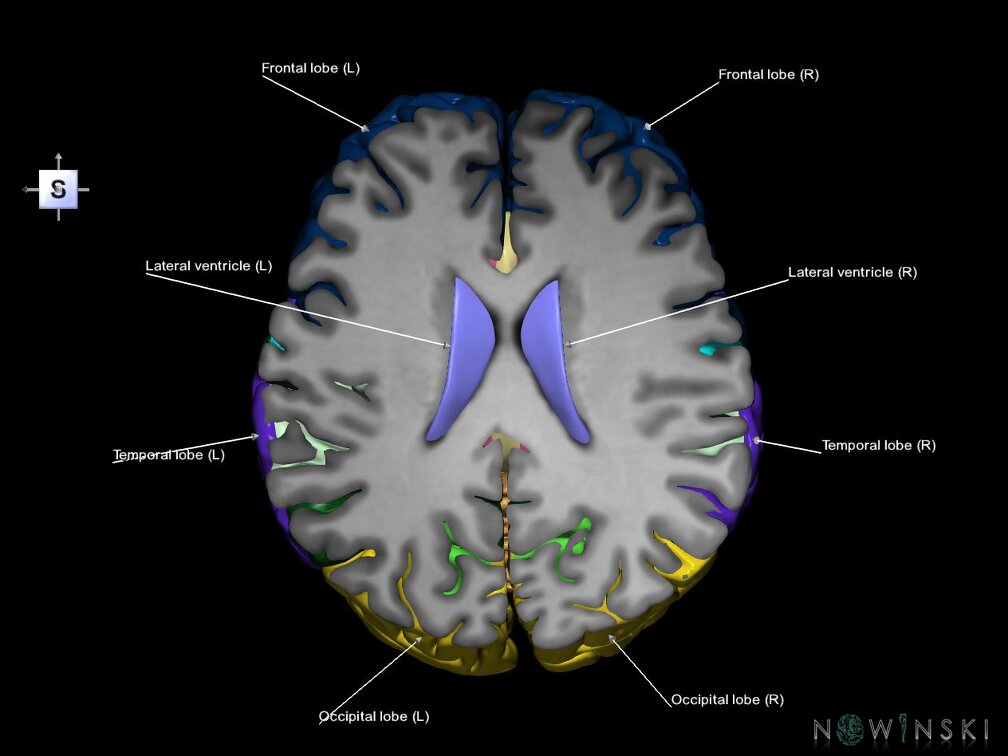 G7.T2.1-12.V5.Ds20.C2.L1.Brain superior cut–Cerebral ventricles