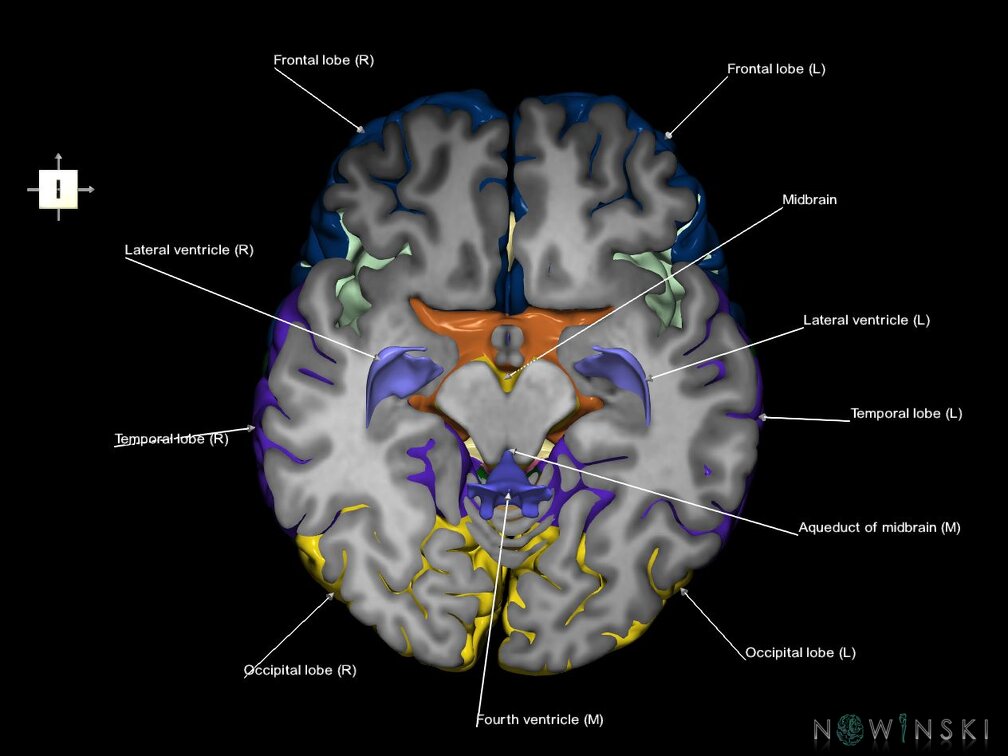 G7.T2.1-12.V6.Di-10.C2.L1.Brain inferior cut–Cerebral ventricles