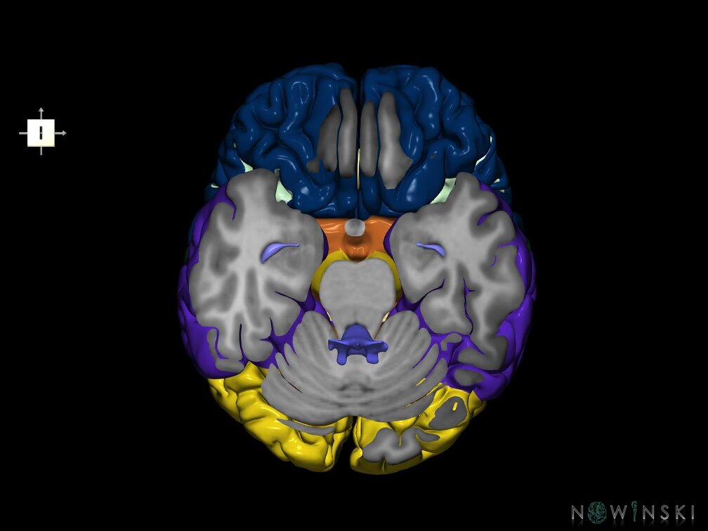 G7.T2.1-12.V6.Di-20.C2.L0.Brain inferior cut–Cerebral ventricles