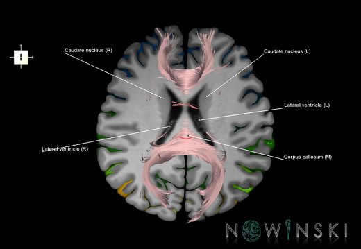 G7.T3.1-14.3.V6.Di20.C3-2.L1.Cerebrum inferior cut–Commissural tracts