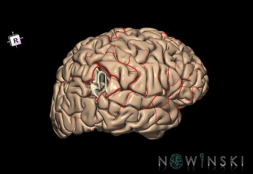 G8.T3.1-6 6.1-13.4-15.2.V8.C1.L0.Cerebrum-No angular gyrus right-White matter-Intracranial arteries