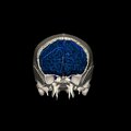 G8.T3.1-16.1-22.2 22.5.3.V1.C2.L0.Cerebrum-Intracranial venous system-Neurocranium-No frontal bone