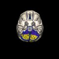G8.T3.1-16.1-22.2 22.5.6.V6.C2.L0.Cerebrum-Intracranial venous system-Neurocranium-No occipital bone