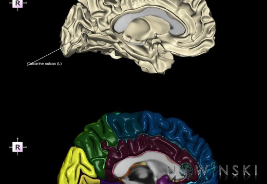 G9.T7.1.DualImageSulci.Calcarine sulcus left