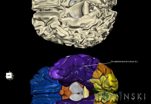 G9.T7.14.DualImageSulci.Occipitotemporal sulcus left
