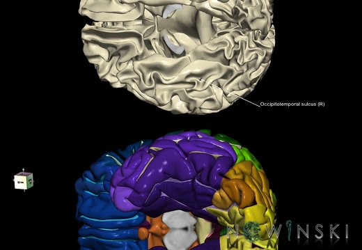 G9.T7.14.DualImageSulci.Occipitotemporal sulcus right