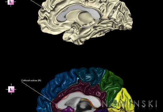 G9.T7.2.DualImageSulci.Callosal sulcus right