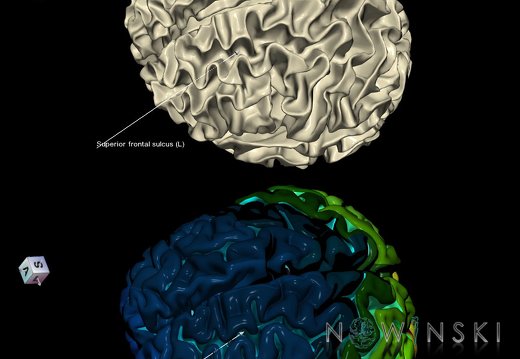 G9.T7.22.DualImageSulci.Superior frontal sulcus left