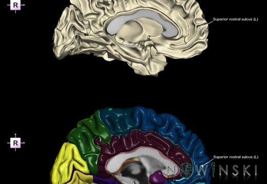 G9.T7.24.DualImageSulci.Superior rostral sulcus left