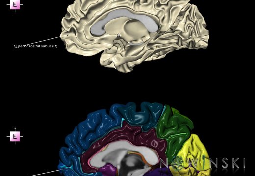 G9.T7.24.DualImageSulci.Superior rostral sulcus right