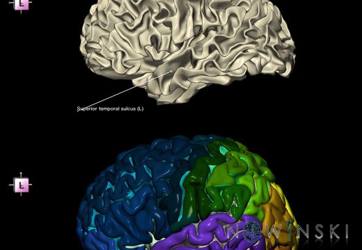 G9.T7.25.DualImageSulci.Superior temporal sulcus left
